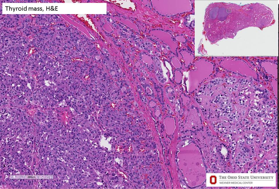 Microscopic image possibly detecting cancerous areas in human tissue