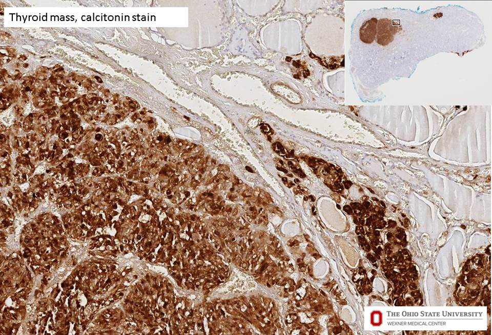 Microscopic image possibly detecting cancerous areas in human tissue