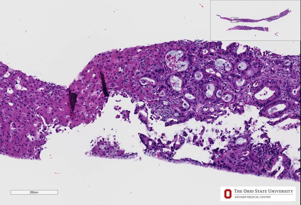 Microscopic image possibly detecting cancerous areas in human tissue