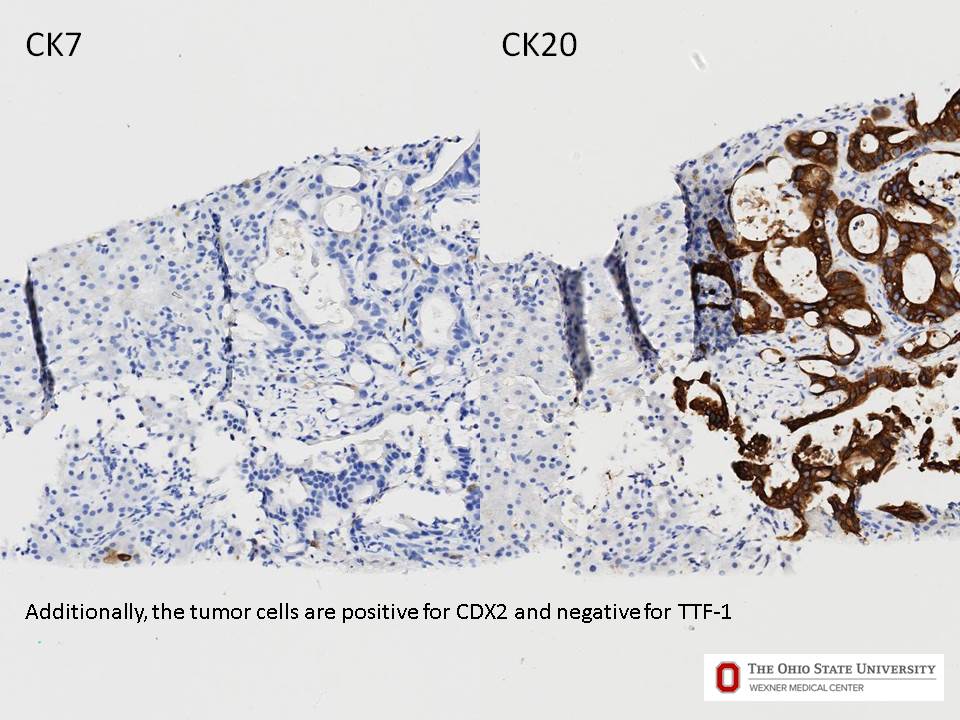 Microscopic image possibly detecting cancerous areas in human tissue