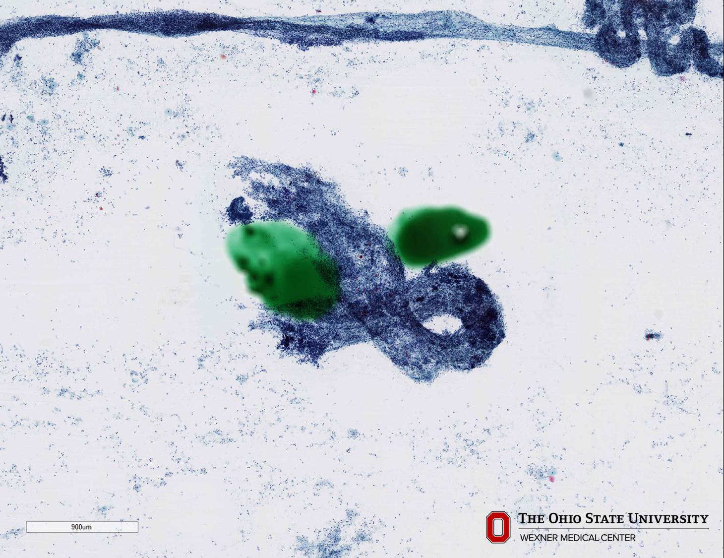 Microscopic image possibly detecting cancerous areas in human tissue