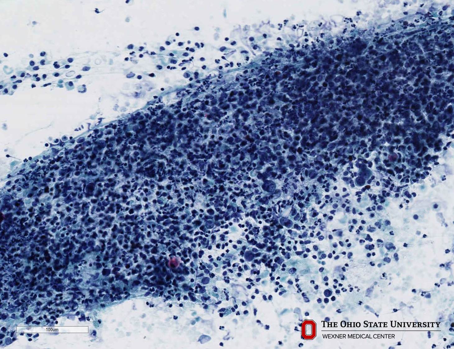 Microscopic image possibly detecting cancerous areas in human tissue