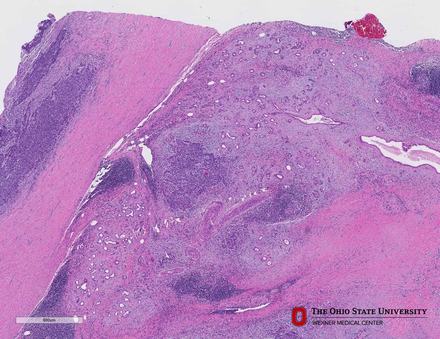 Microscopic image possibly detecting cancerous areas in human tissue