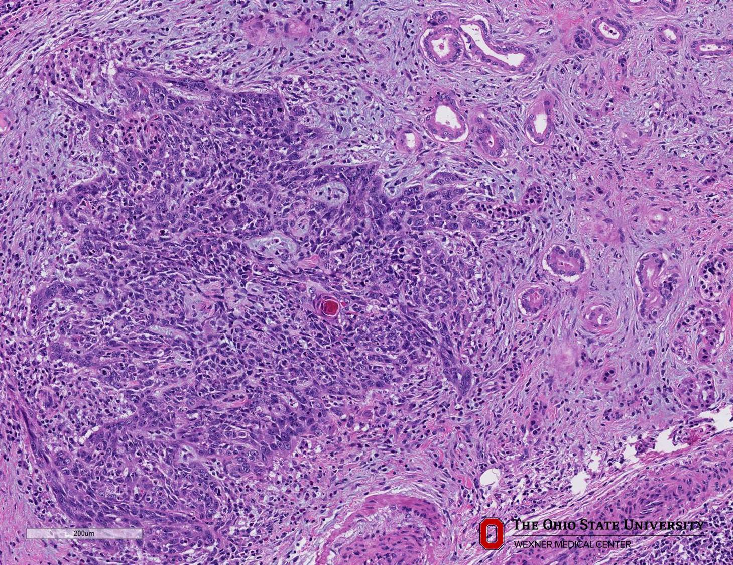 Microscopic image possibly detecting cancerous areas in human tissue