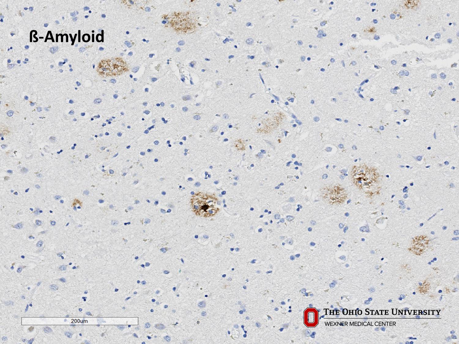 Microscopic image possibly detecting cancerous areas in human tissue