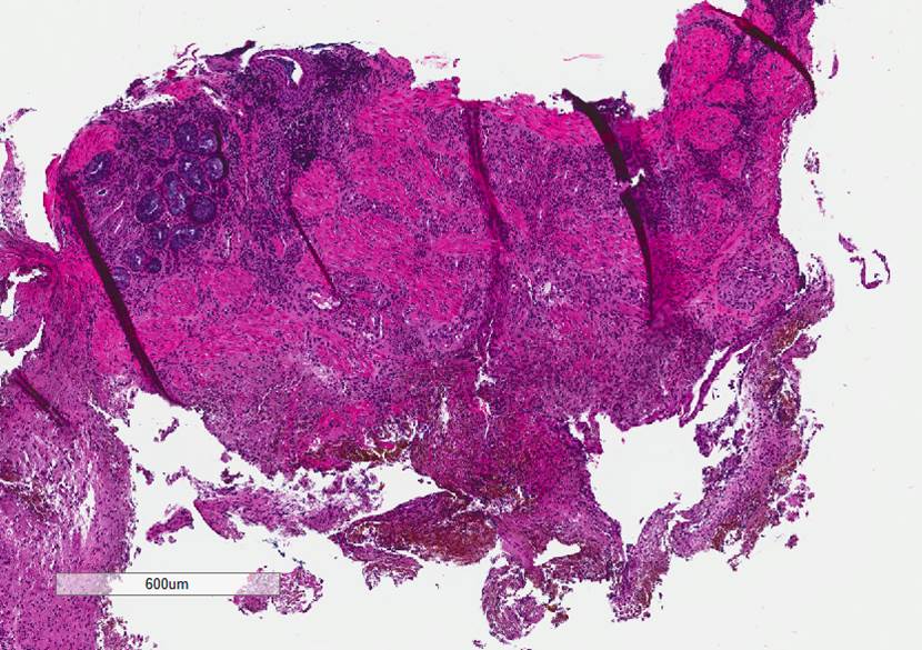 Microscopic image possibly detecting cancerous areas in human tissue