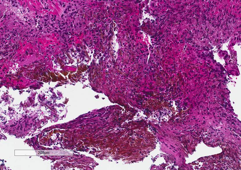 Microscopic image possibly detecting cancerous areas in human tissue