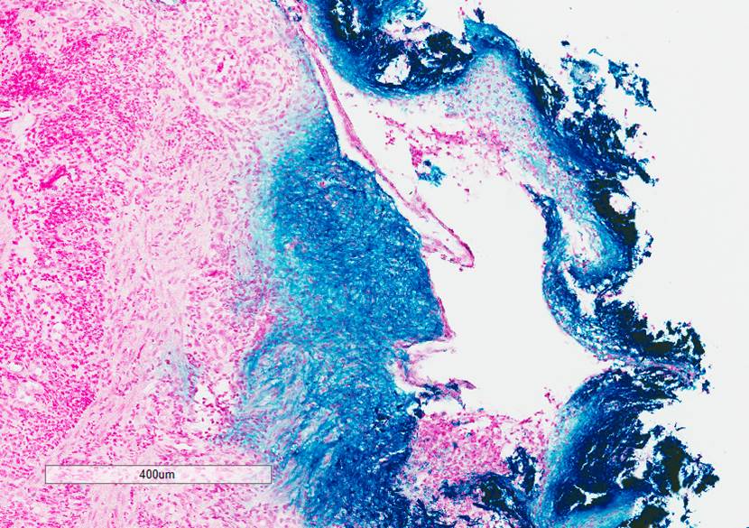 Microscopic image possibly detecting cancerous areas in human tissue