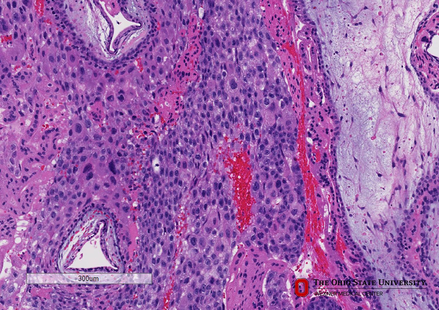 Microscopic image possibly detecting cancerous areas in human tissue