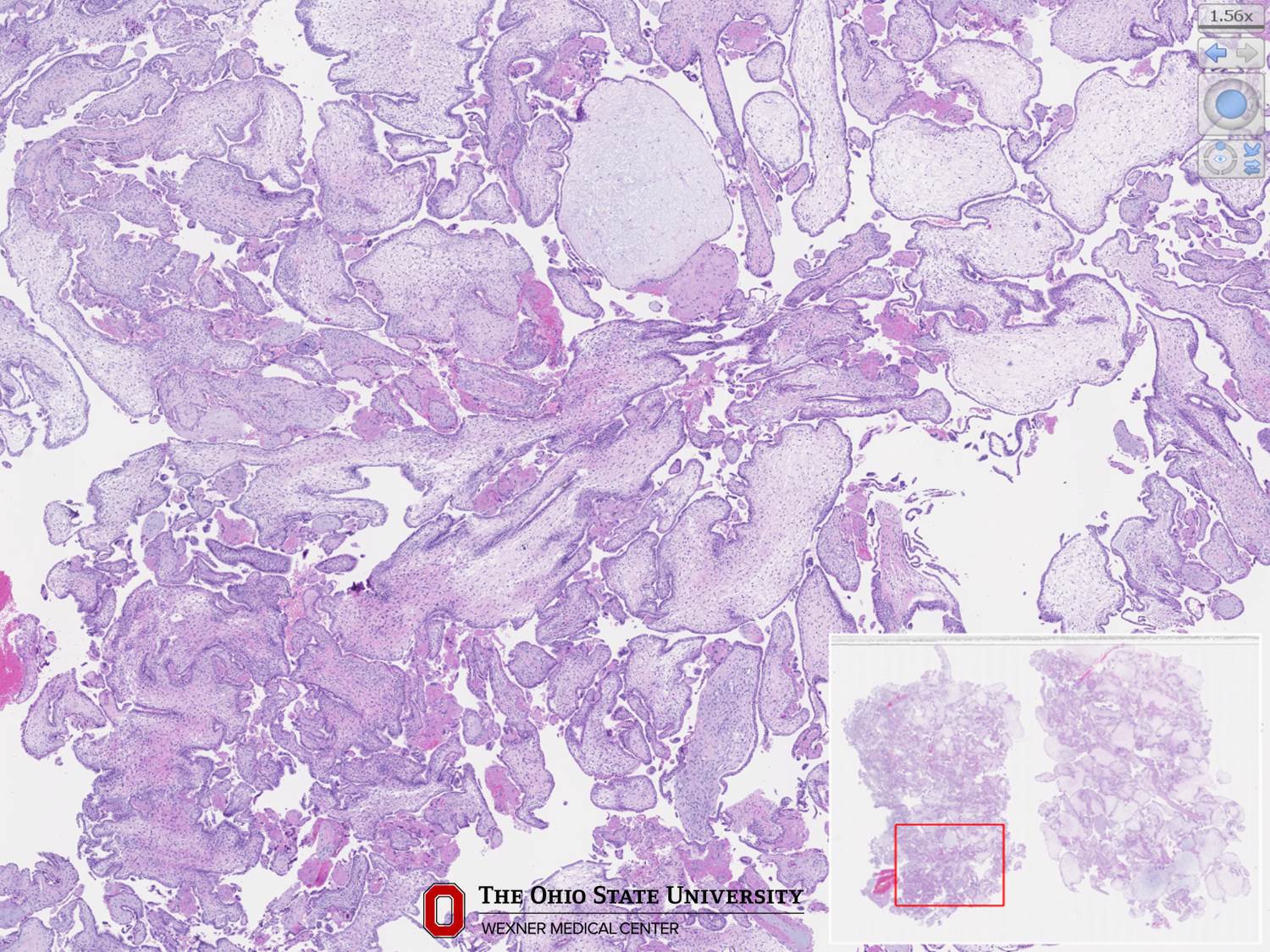 Microscopic image possibly detecting cancerous areas in human tissue