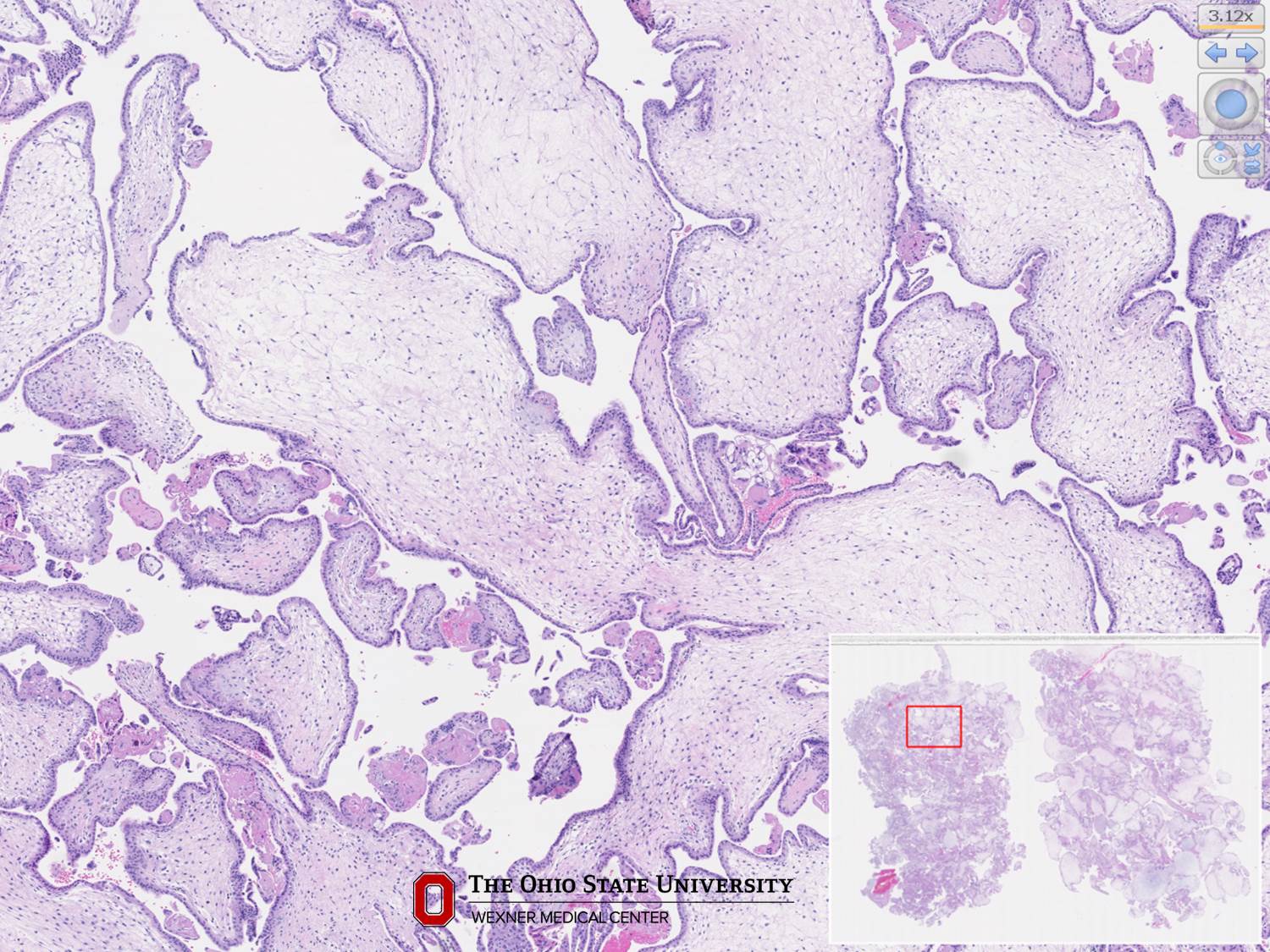 Microscopic image possibly detecting cancerous areas in human tissue