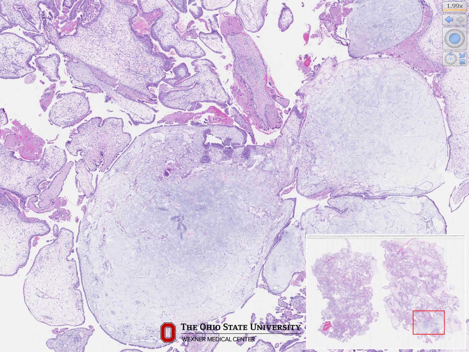 Microscopic image possibly detecting cancerous areas in human tissue