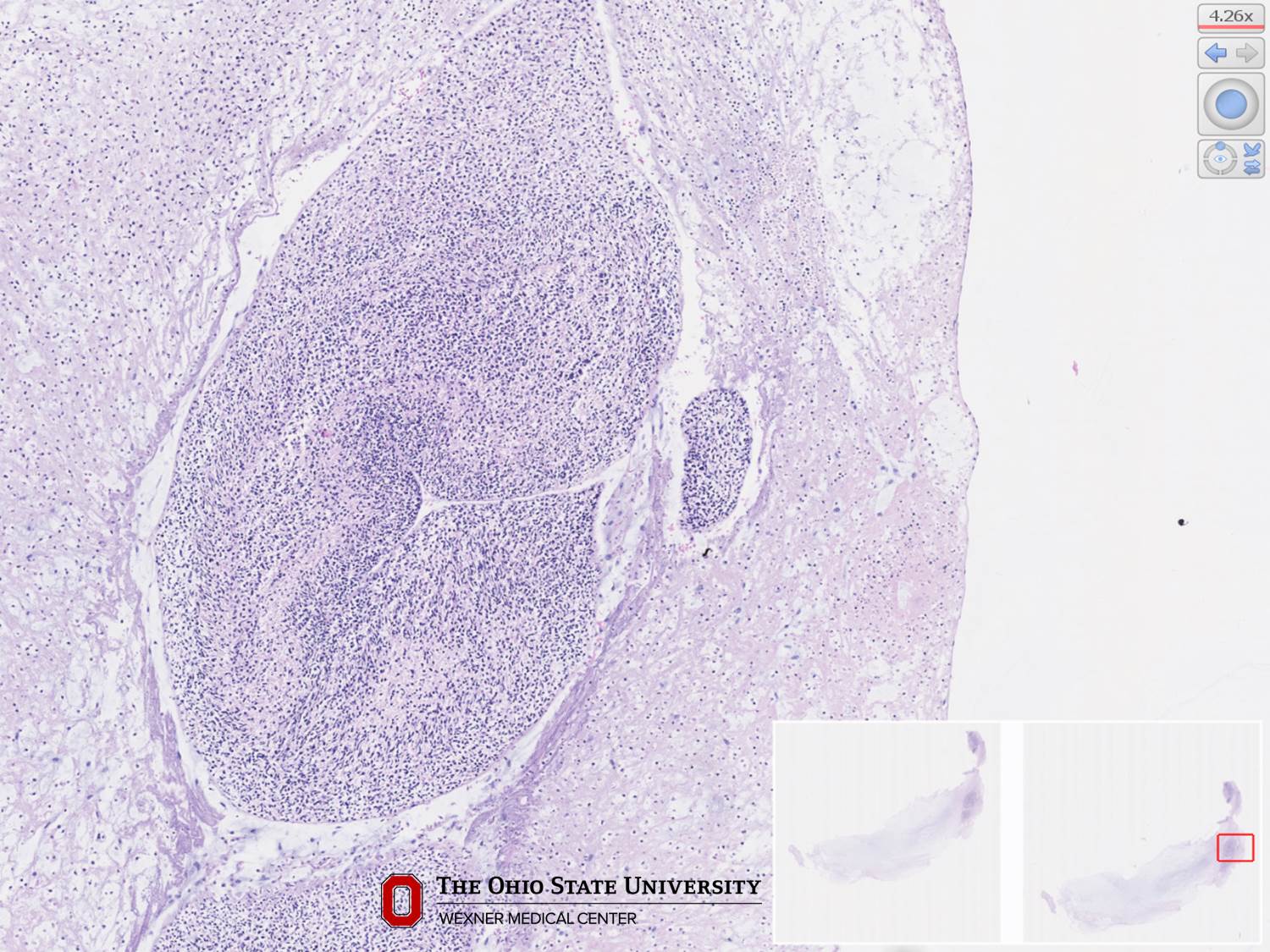 Microscopic image possibly detecting cancerous areas in human tissue