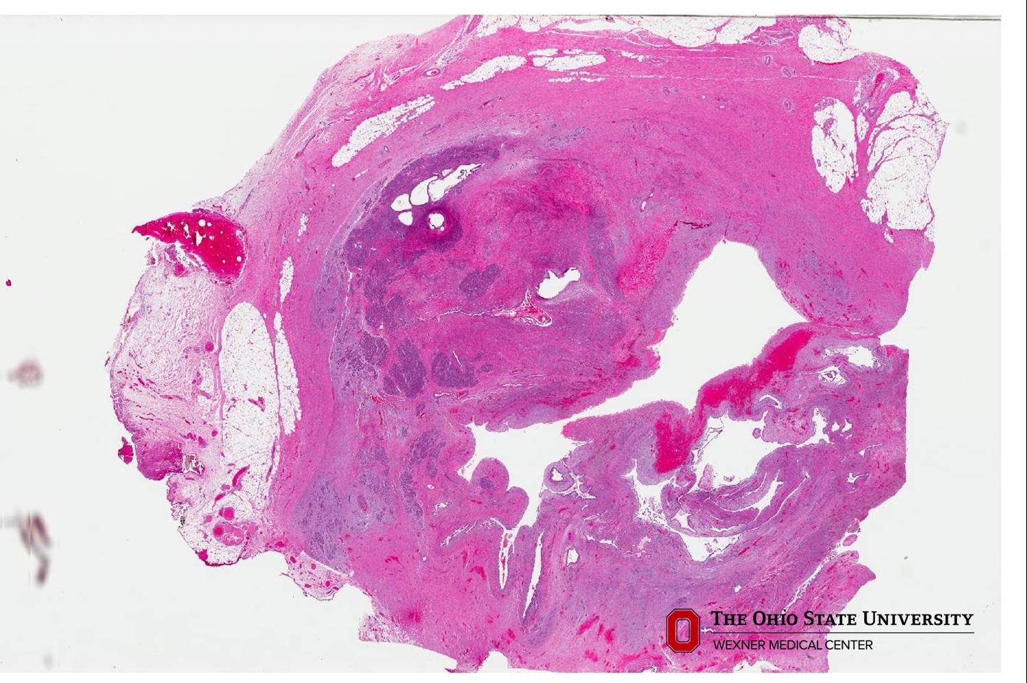 Microscopic image possibly detecting cancerous areas in human tissue