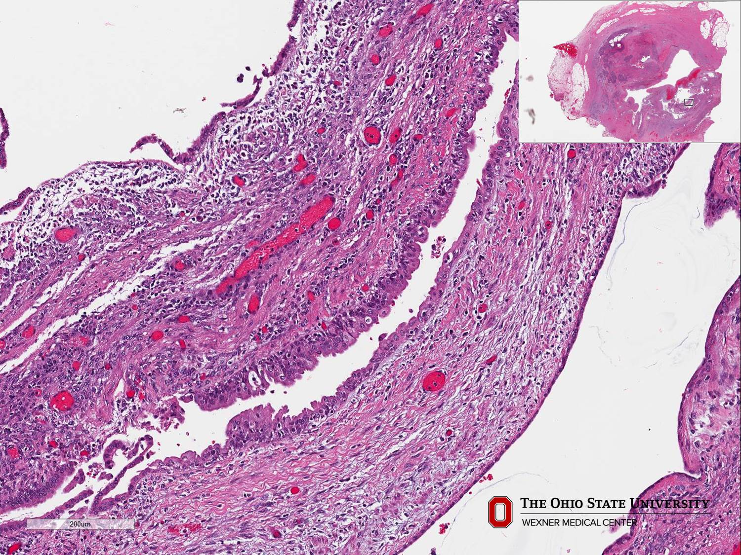 Microscopic image possibly detecting cancerous areas in human tissue