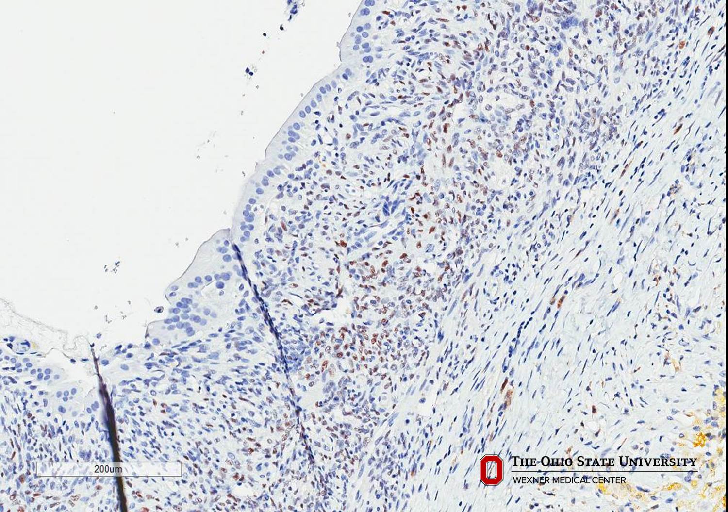 Microscopic image possibly detecting cancerous areas in human tissue