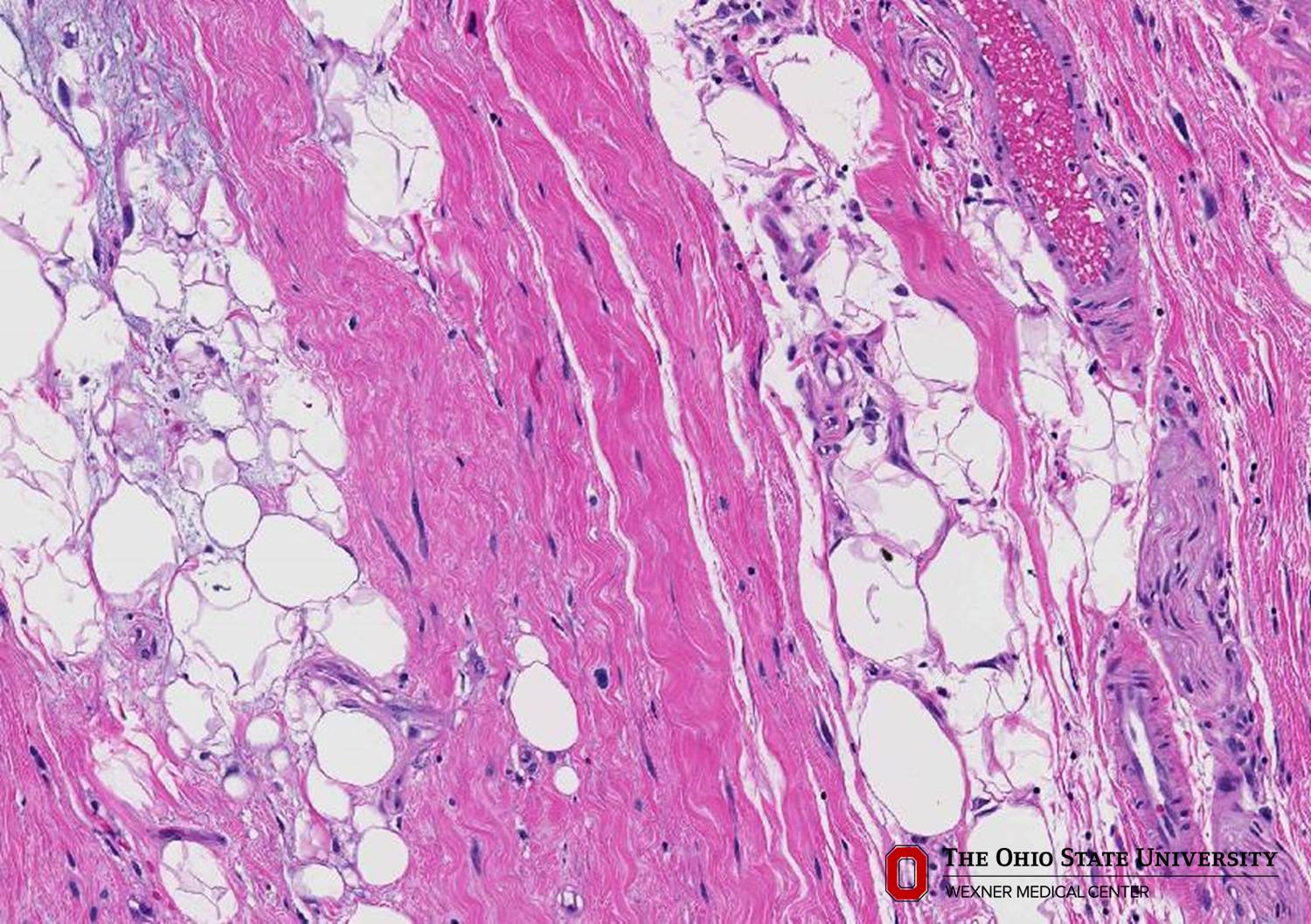 Microscopic image possibly detecting cancerous areas in human tissue