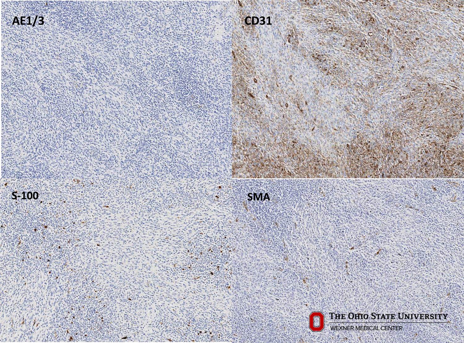 Microscopic image possibly detecting cancerous areas in human tissue