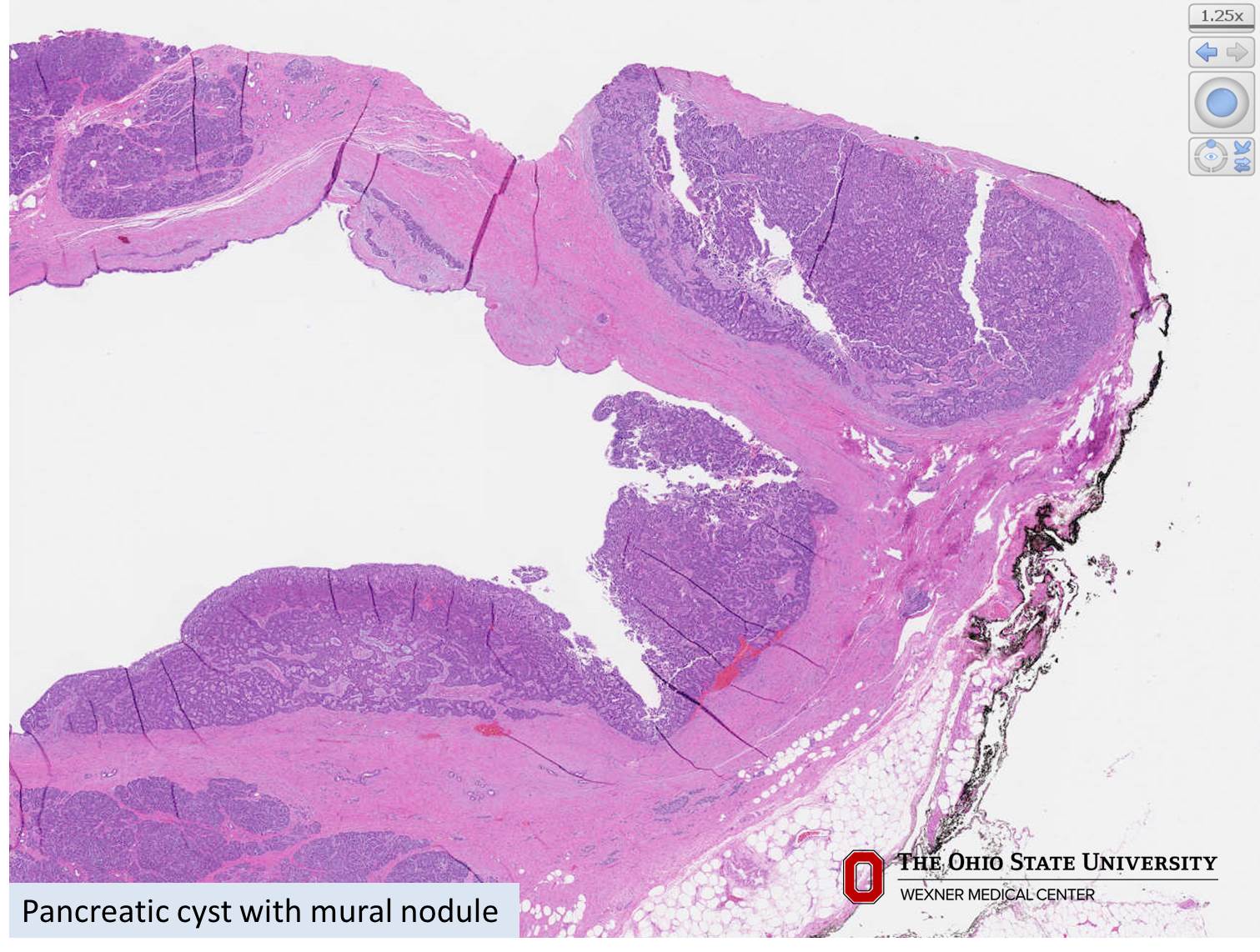 Microscopic image possibly detecting cancerous areas in human tissue