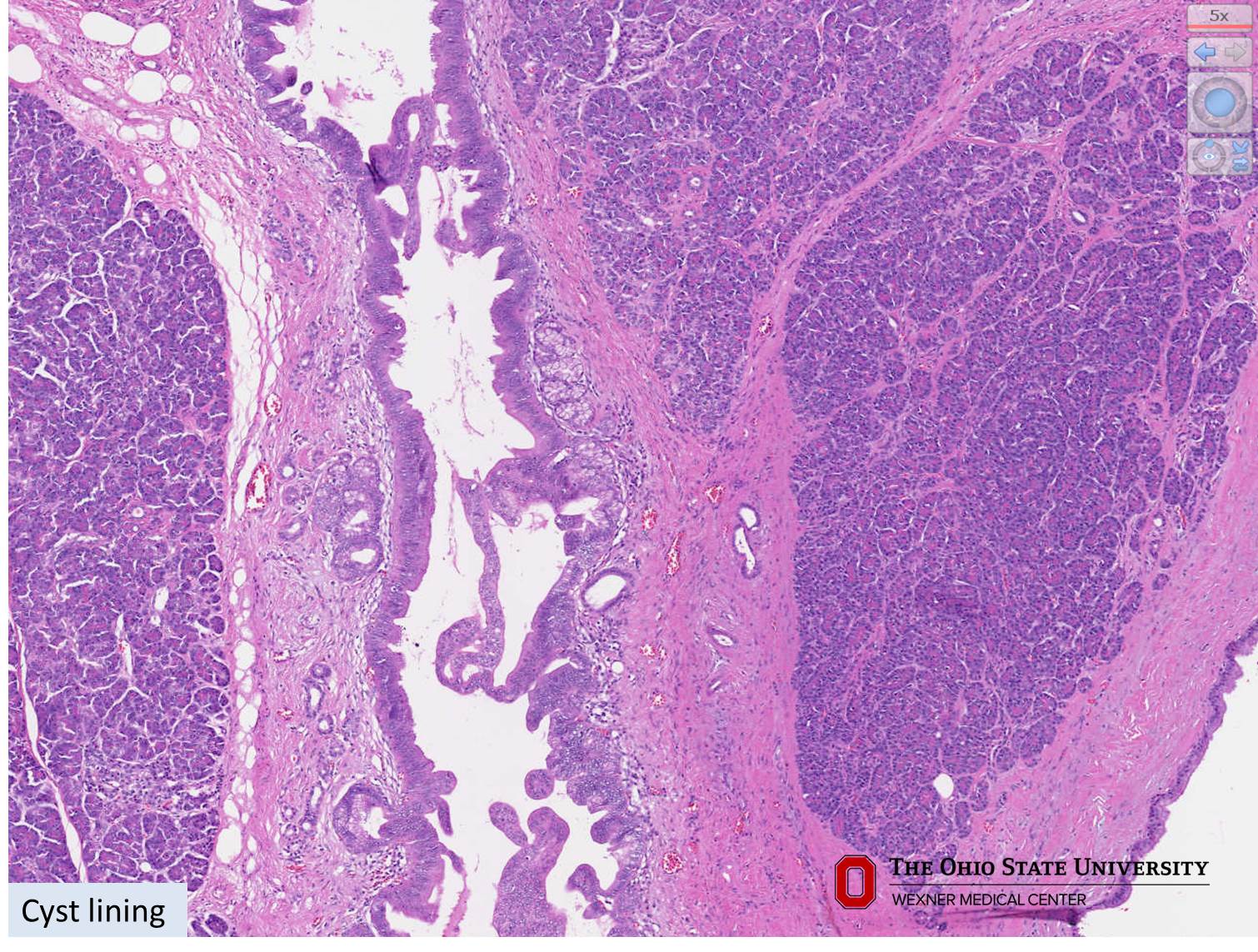 Microscopic image possibly detecting cancerous areas in human tissue