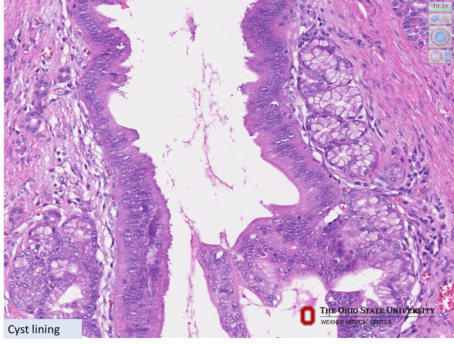 Microscopic image possibly detecting cancerous areas in human tissue