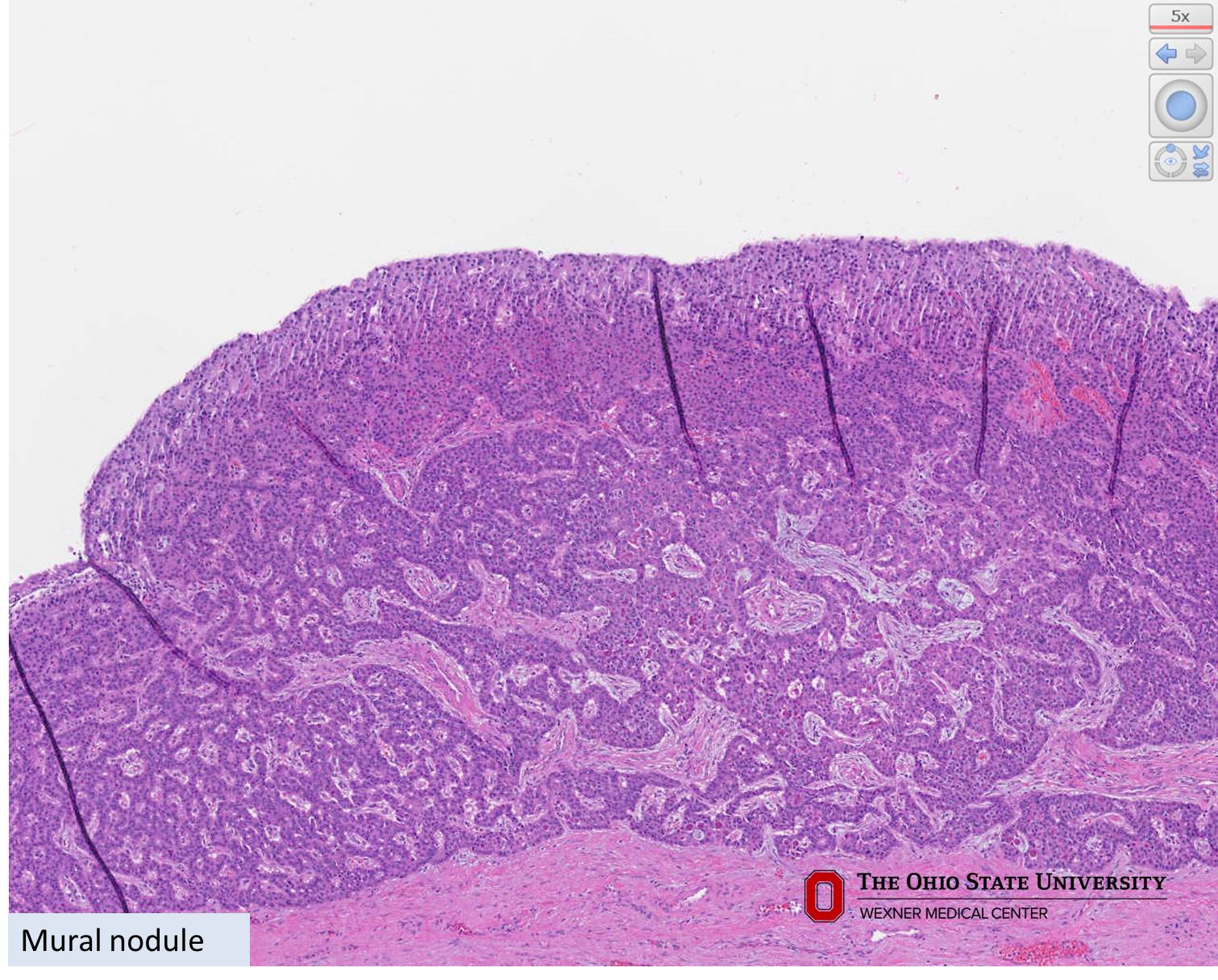 Microscopic image possibly detecting cancerous areas in human tissue