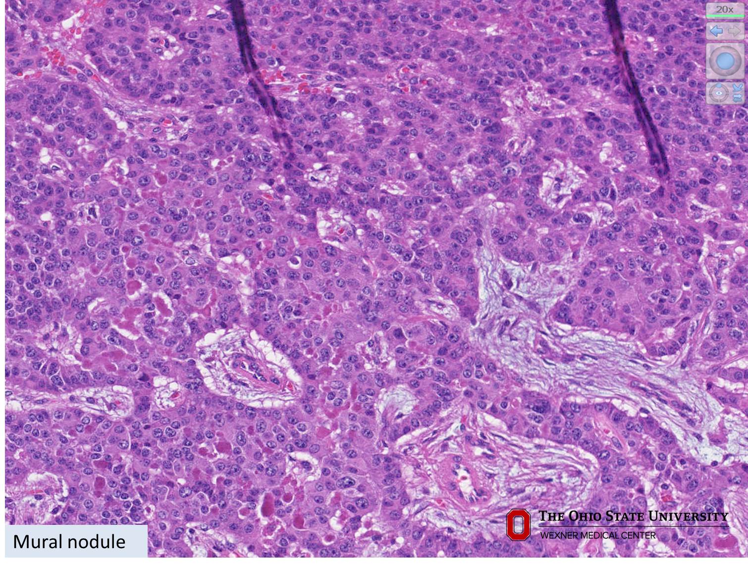 Microscopic image possibly detecting cancerous areas in human tissue