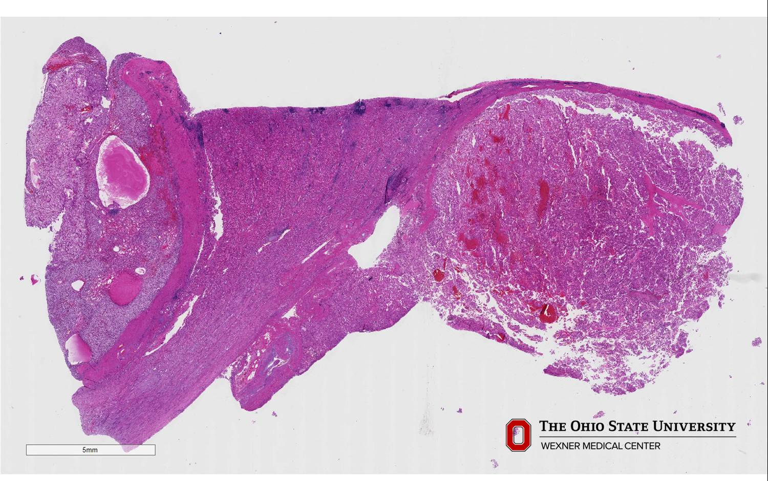 Microscopic image possibly detecting cancerous areas in human tissue