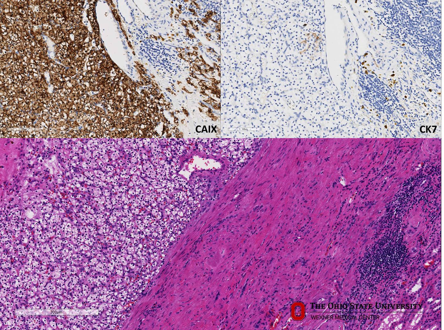 Microscopic image possibly detecting cancerous areas in human tissue