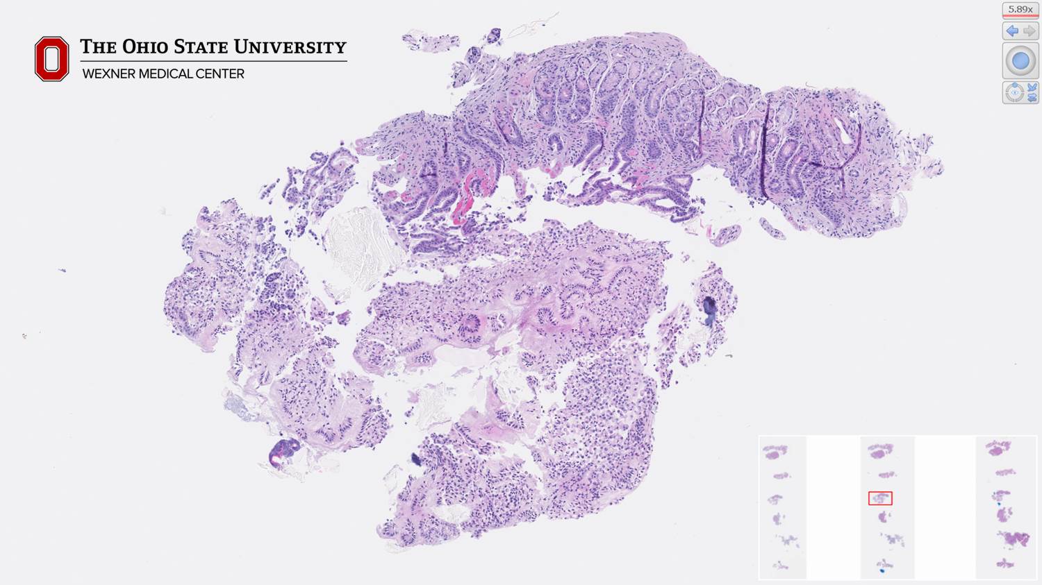 Microscopic image possibly detecting cancerous areas in human tissue