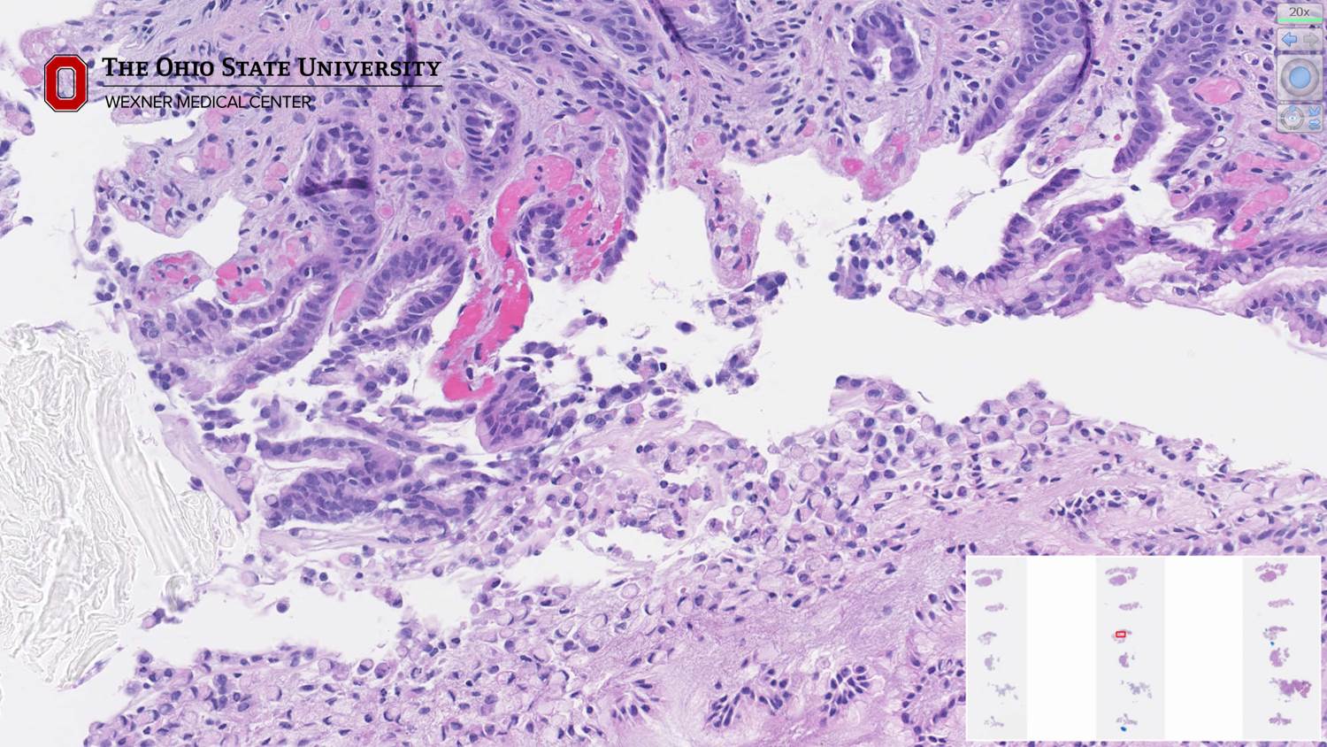 Microscopic image possibly detecting cancerous areas in human tissue