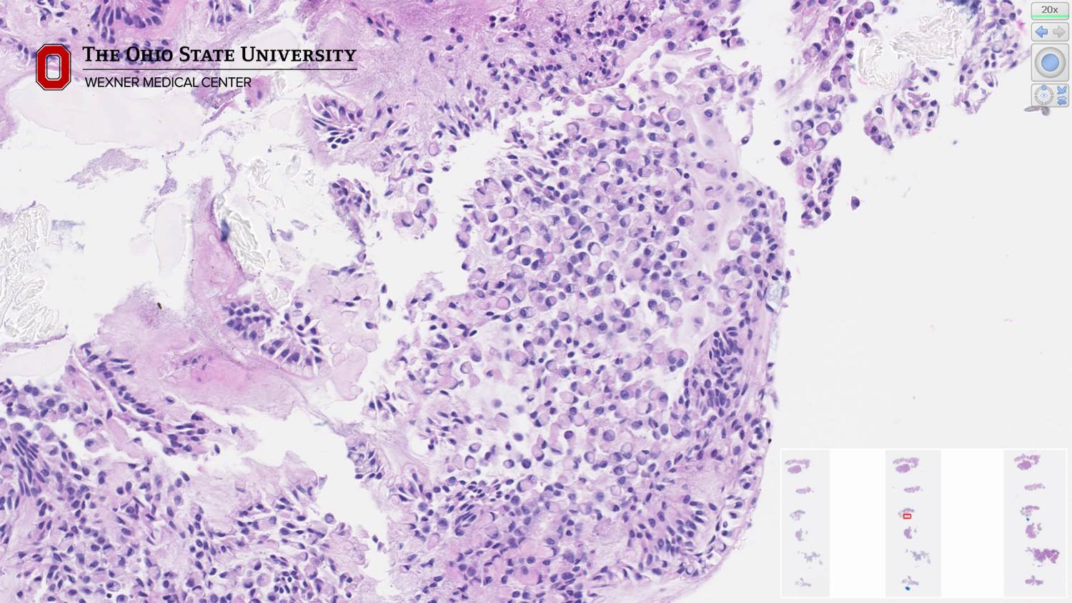 Microscopic image possibly detecting cancerous areas in human tissue