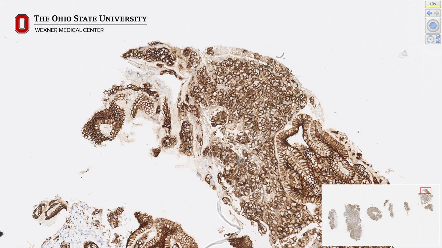 Microscopic image possibly detecting cancerous areas in human tissue