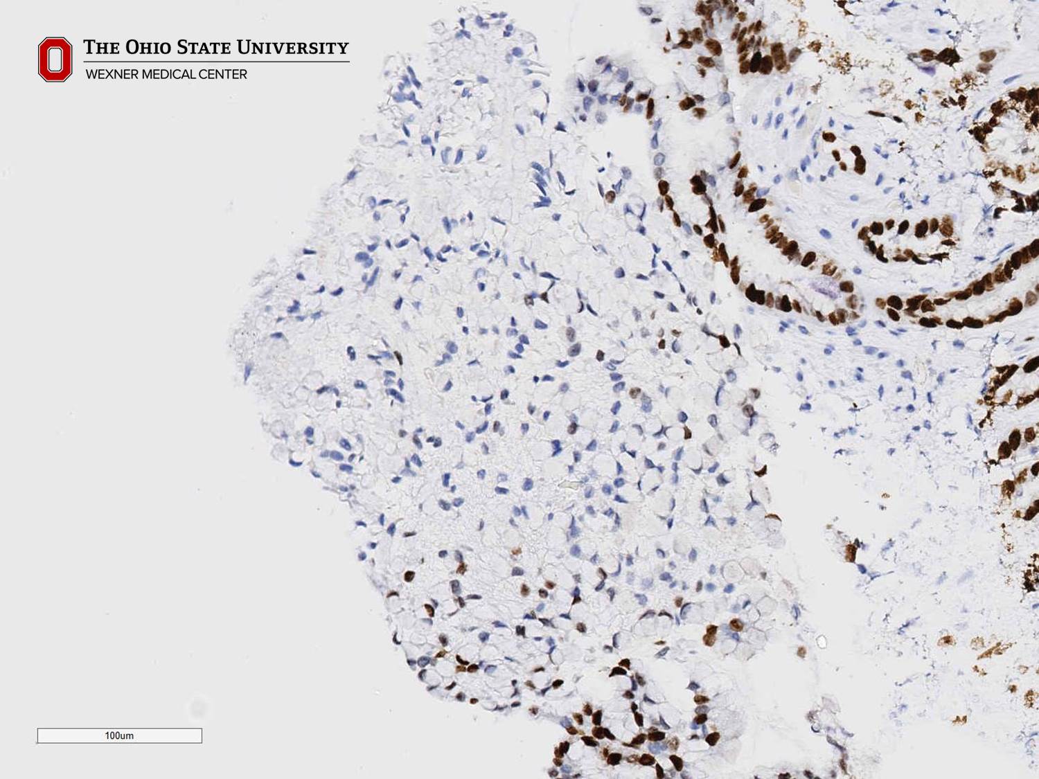 Microscopic image possibly detecting cancerous areas in human tissue