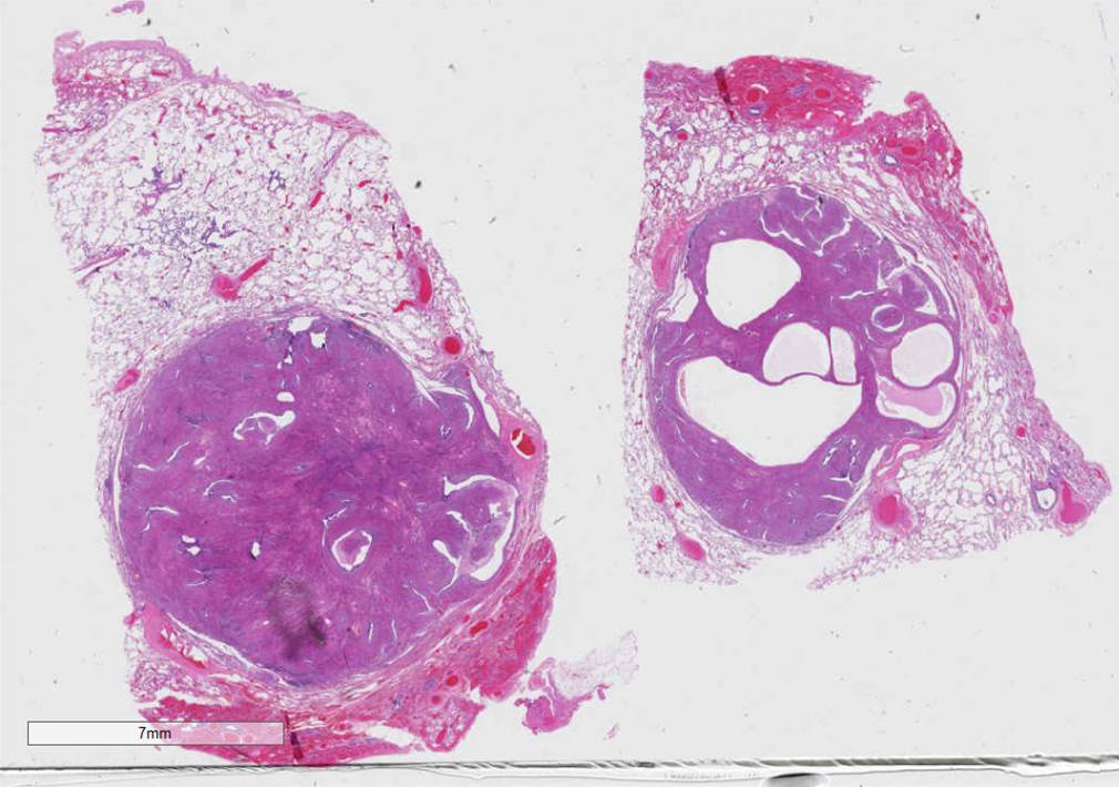 Microscopic image possibly detecting cancerous areas in human tissue