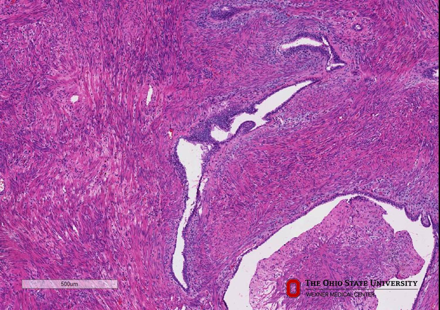 Microscopic image possibly detecting cancerous areas in human tissue