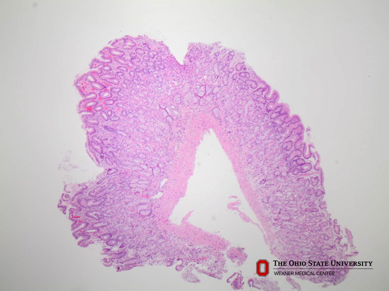 Microscopic image possibly detecting cancerous areas in human tissue