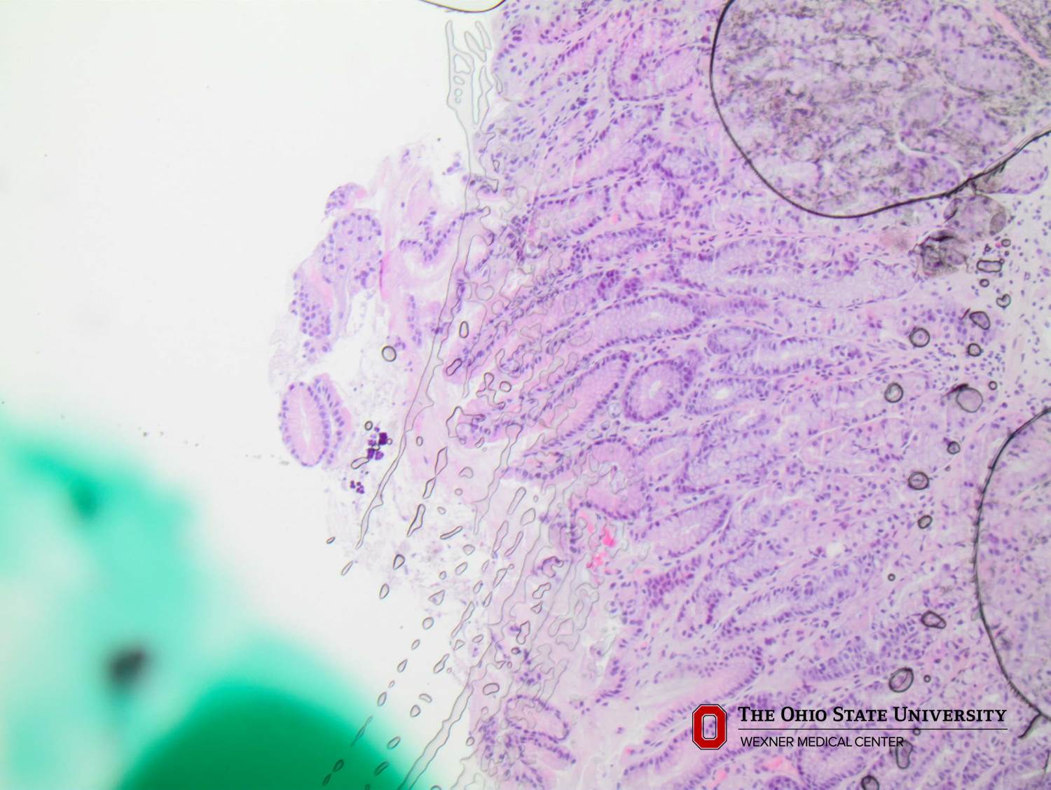 Microscopic image possibly detecting cancerous areas in human tissue