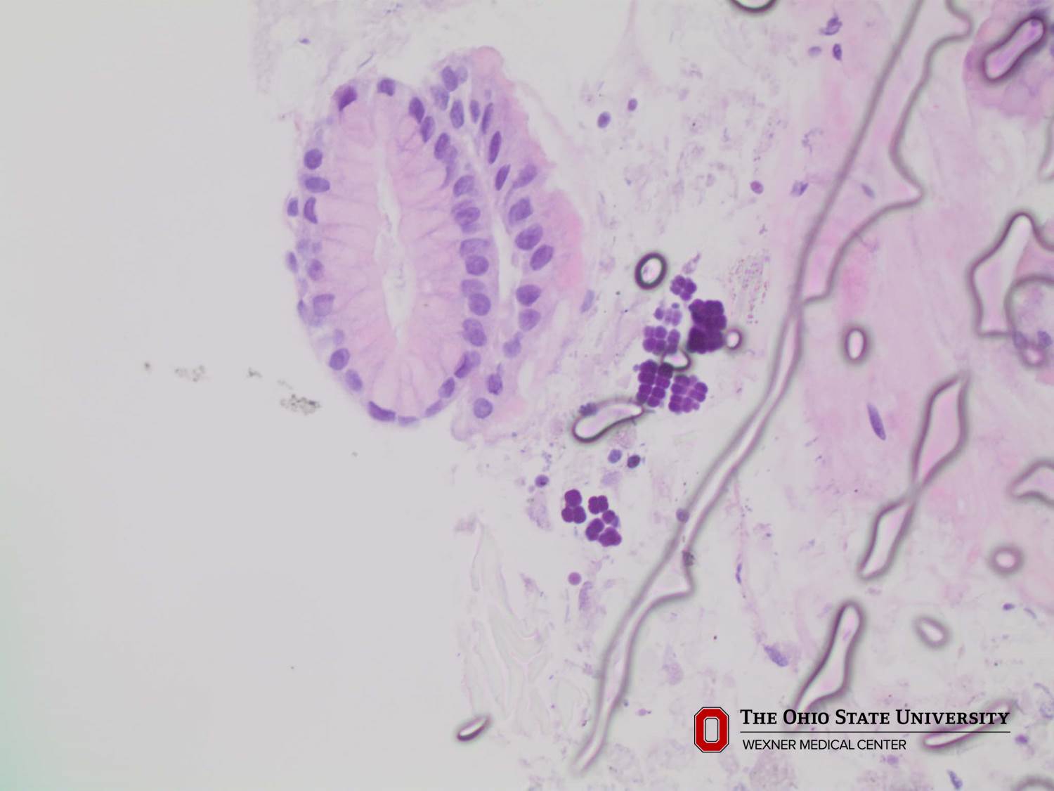 Microscopic image possibly detecting cancerous areas in human tissue