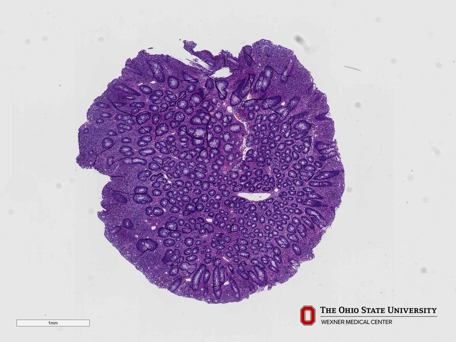 Microscopic image possibly detecting cancerous areas in human tissue