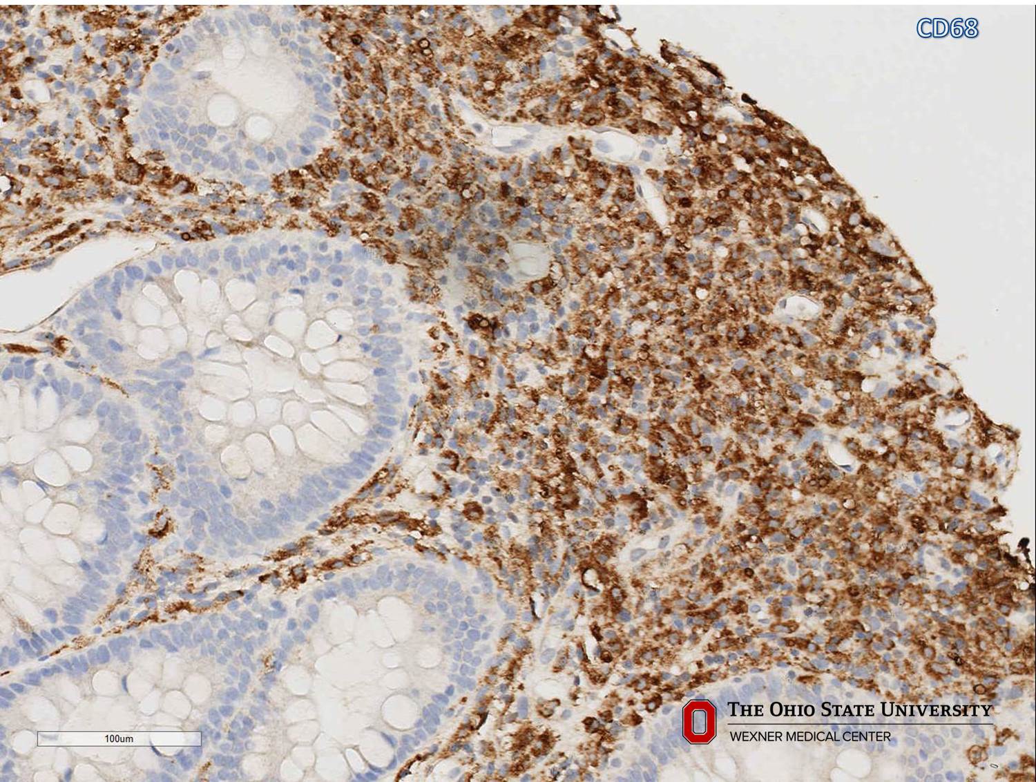 Microscopic image possibly detecting cancerous areas in human tissue