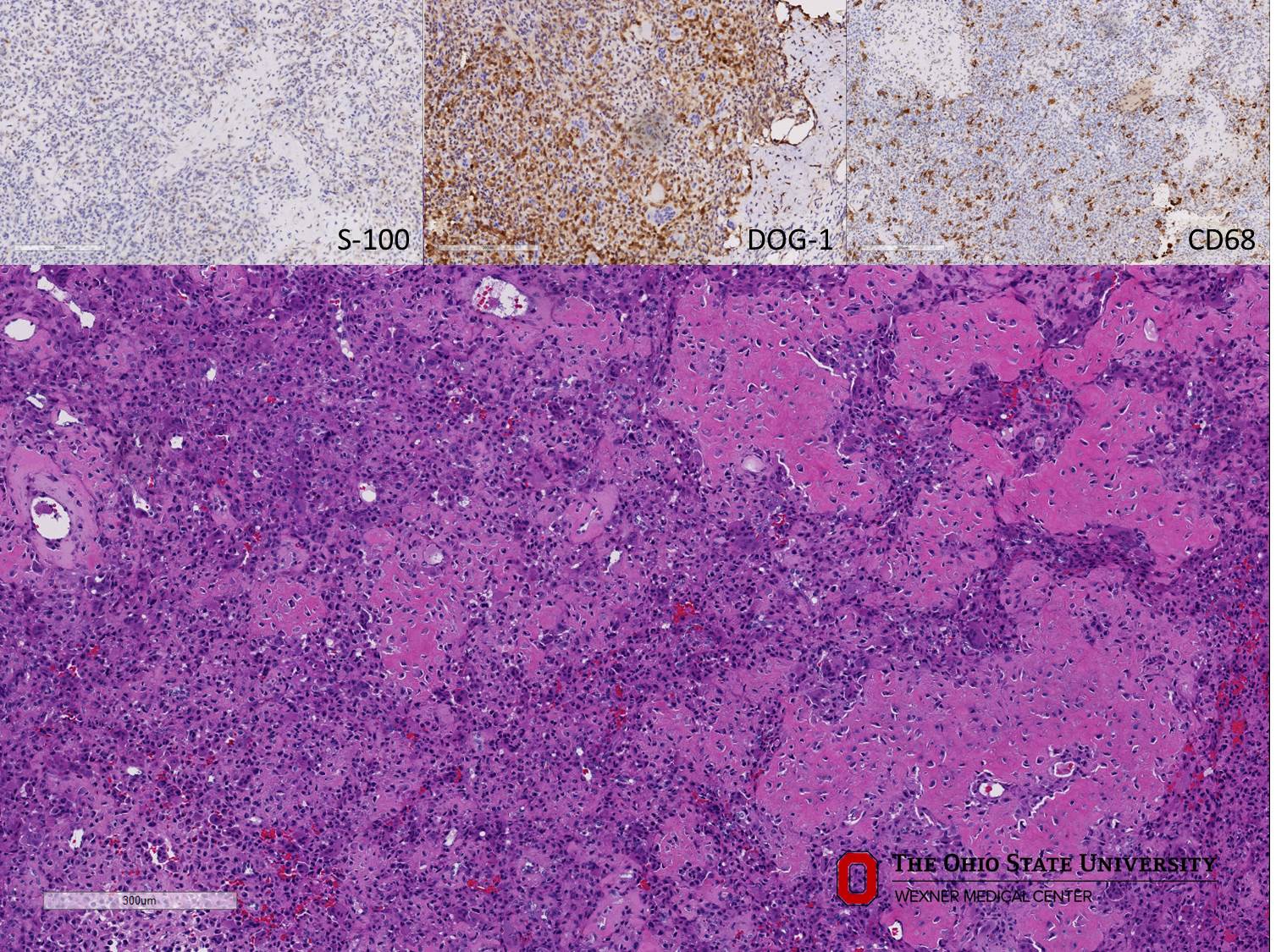 Microscopic image possibly detecting cancerous areas in human tissue