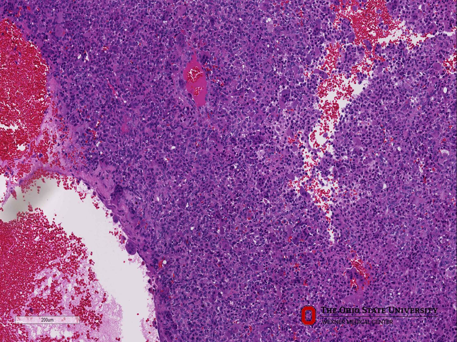 Microscopic image possibly detecting cancerous areas in human tissue