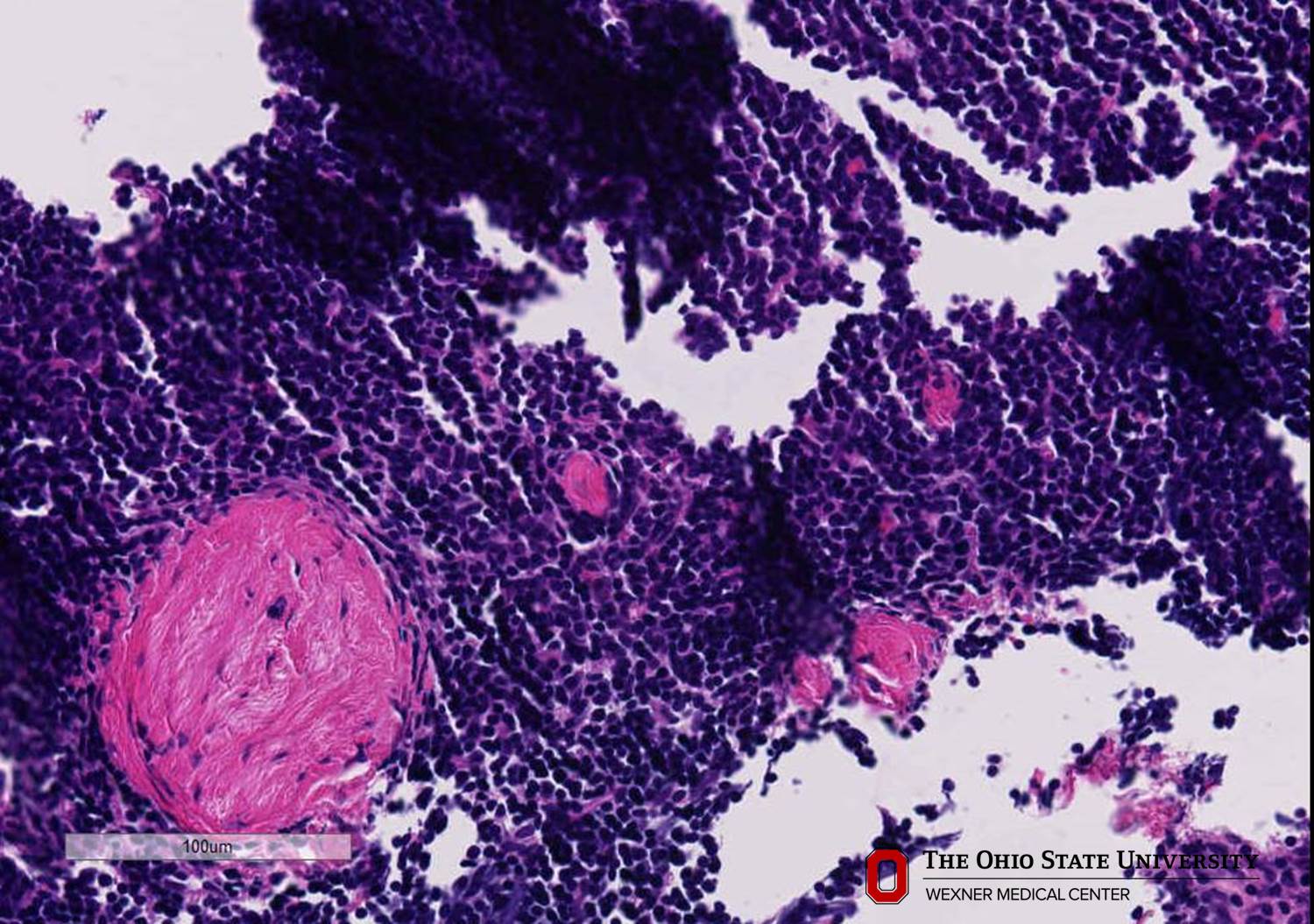 Microscopic image possibly detecting cancerous areas in human tissue