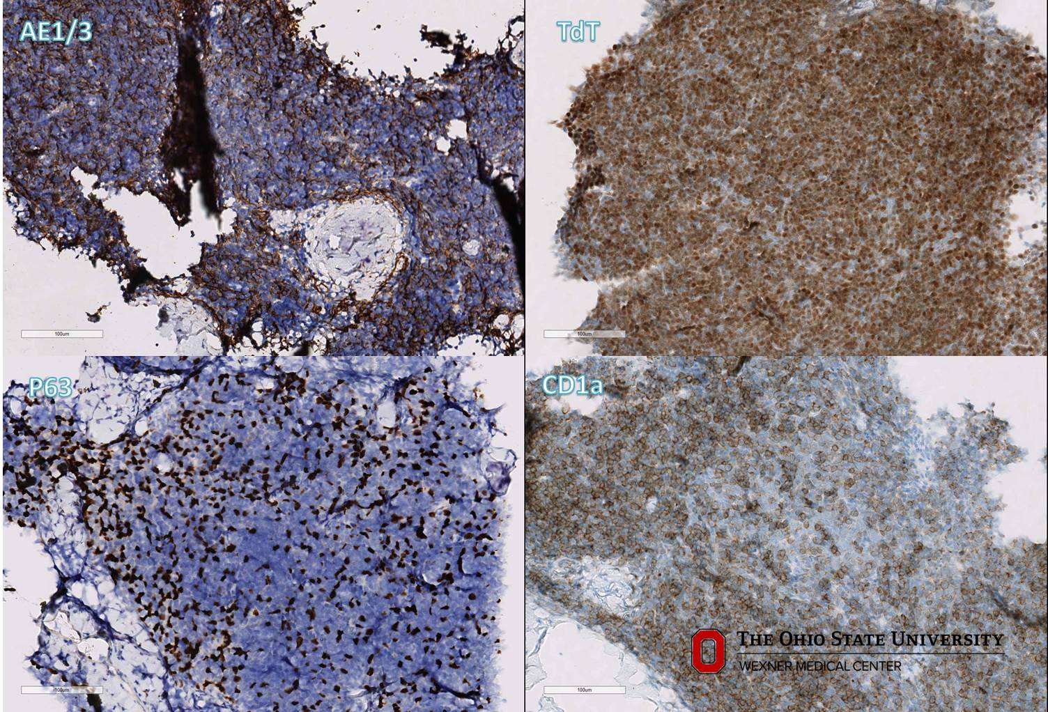 Microscopic image possibly detecting cancerous areas in human tissue