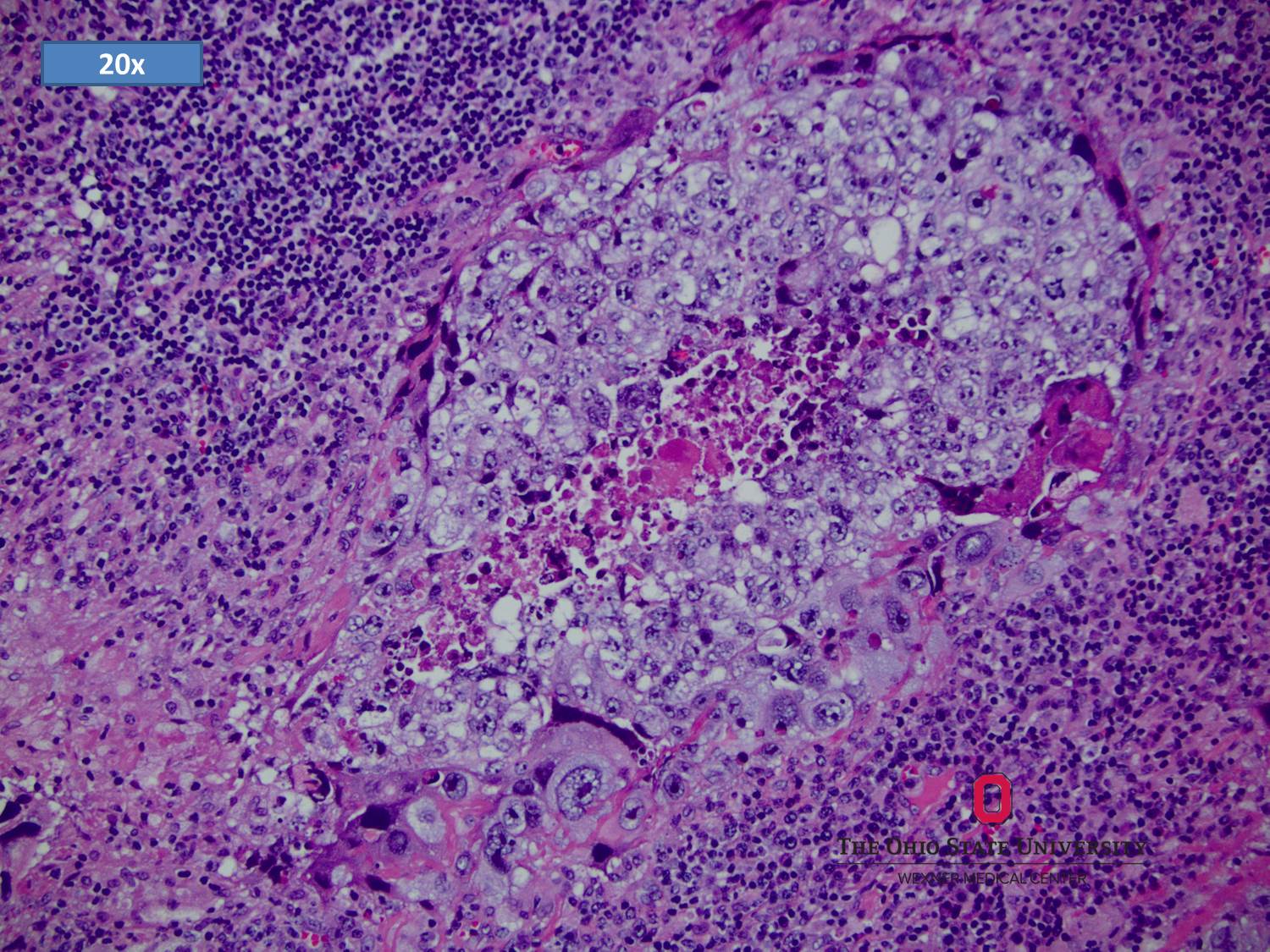 Microscopic image possibly detecting cancerous areas in human tissue