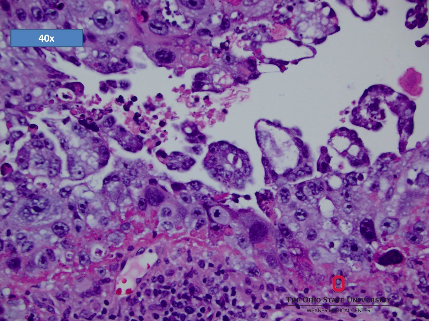 Microscopic image possibly detecting cancerous areas in human tissue