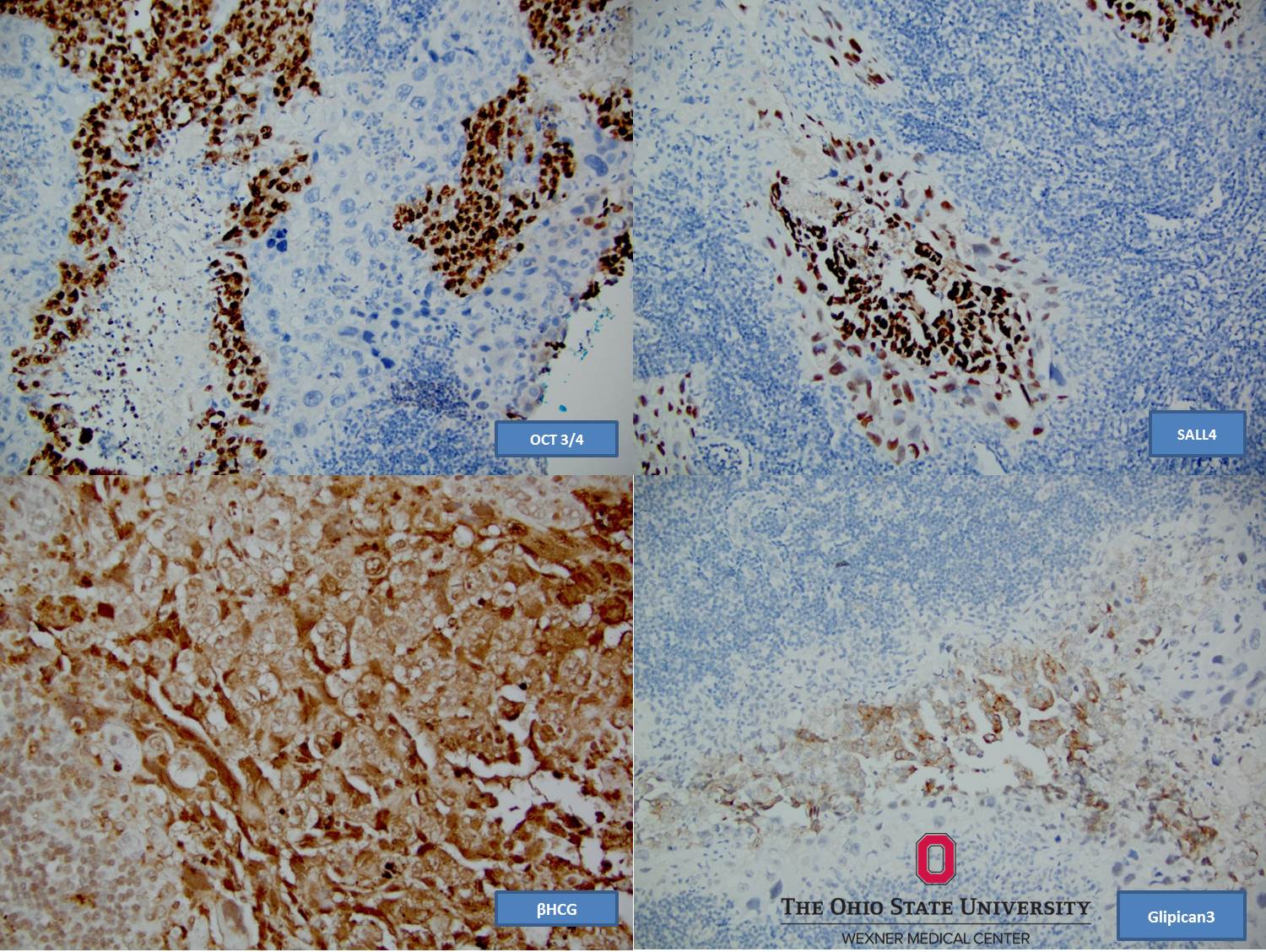 Microscopic image possibly detecting cancerous areas in human tissue