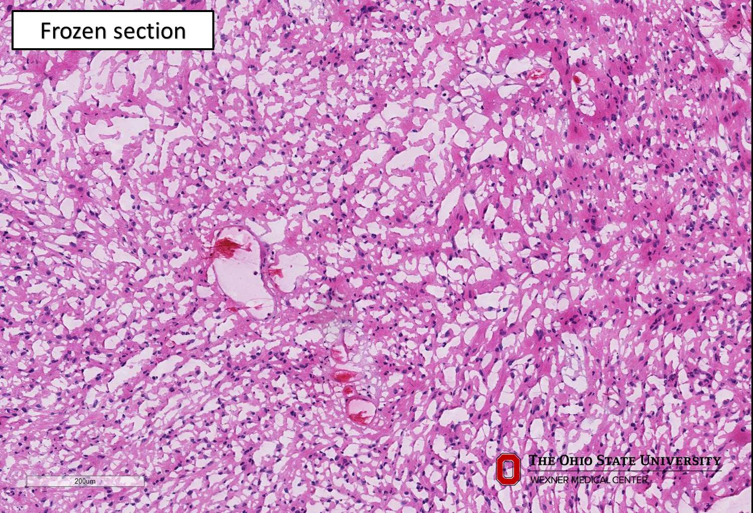 Microscopic image possibly detecting cancerous areas in human tissue