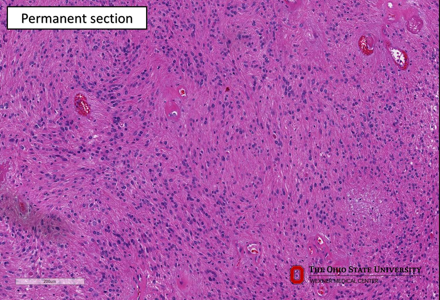 Microscopic image possibly detecting cancerous areas in human tissue